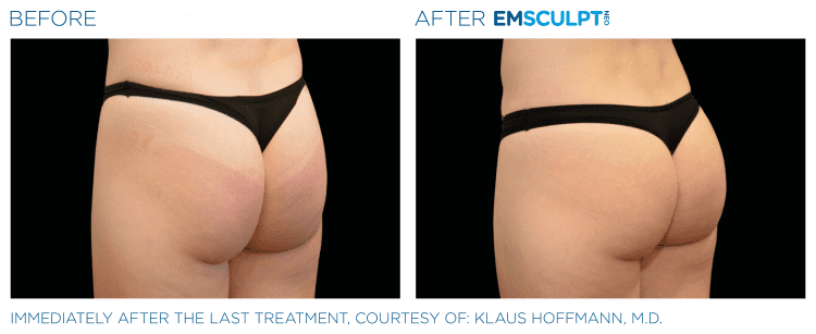 Emsculpt NEO Before & After | Body Sculpting