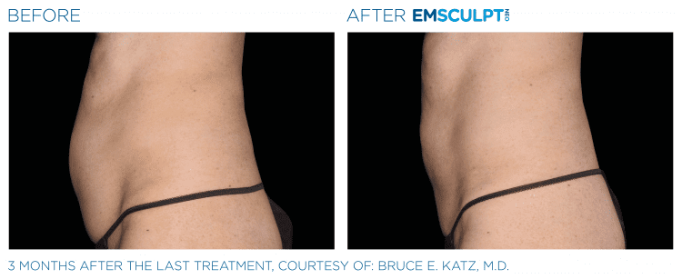 Emsculpt NEO Before & After | Body Sculpting