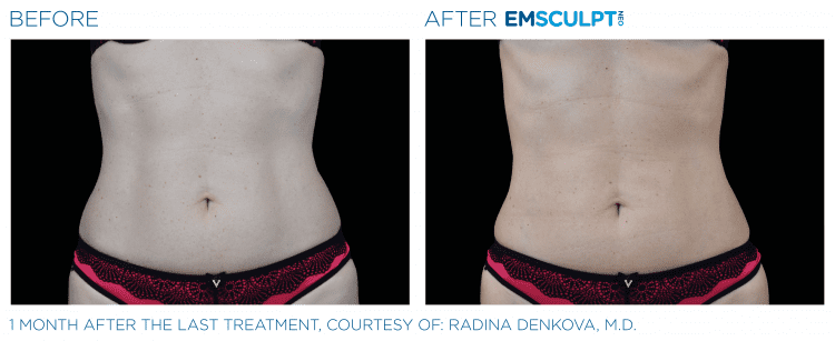 Emsculpt NEO Before & After | Body Sculpting