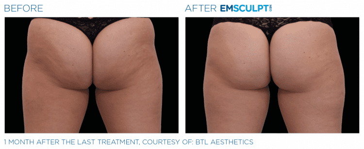 Emsculpt NEO Before & After | Body Sculpting