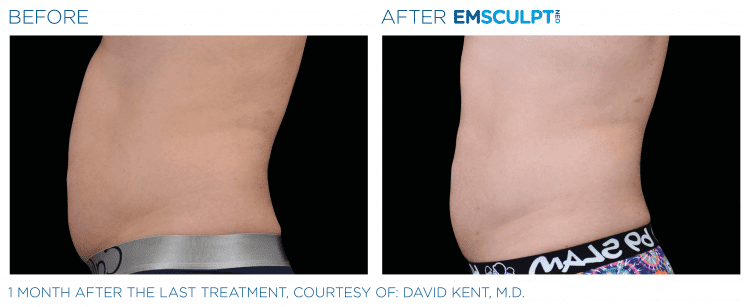 Emsculpt NEO Before & After | Body Sculpting