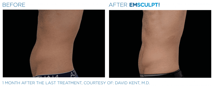 Emsculpt NEO Before & After | Body Sculpting