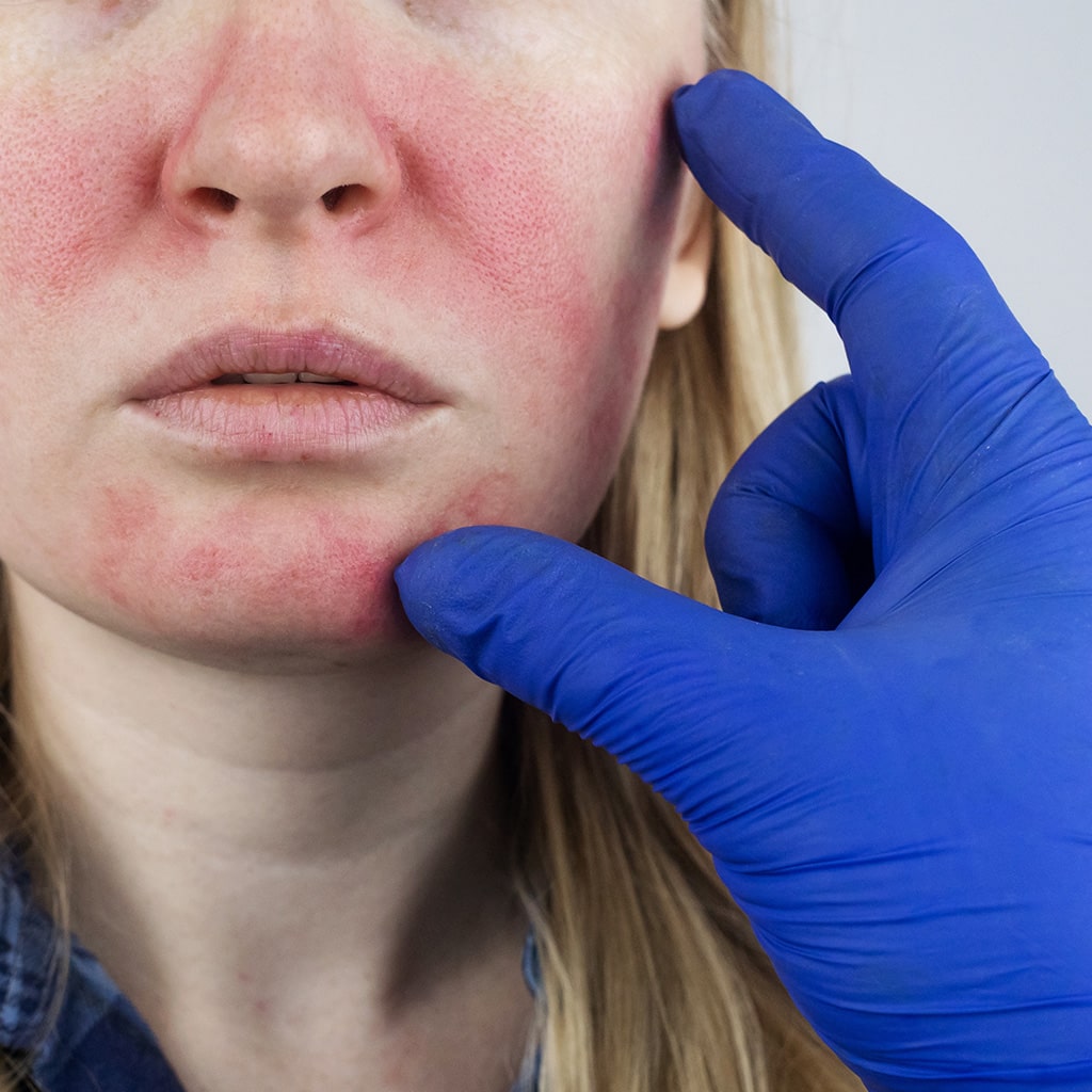 Close-up of a face with rosacea and redness before IPL Rosacea Treatment in Modesto