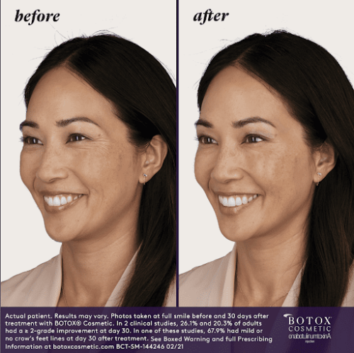 BOTOX Before & After | Injections