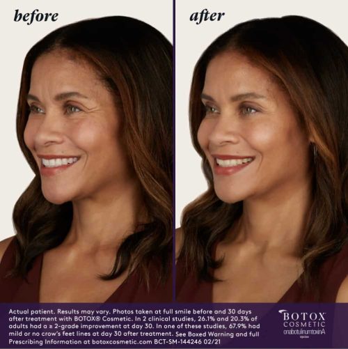 BOTOX Before & After | Injections