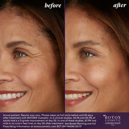 BOTOX Before & After | Injections