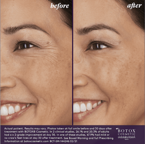 BOTOX Before & After | Injections